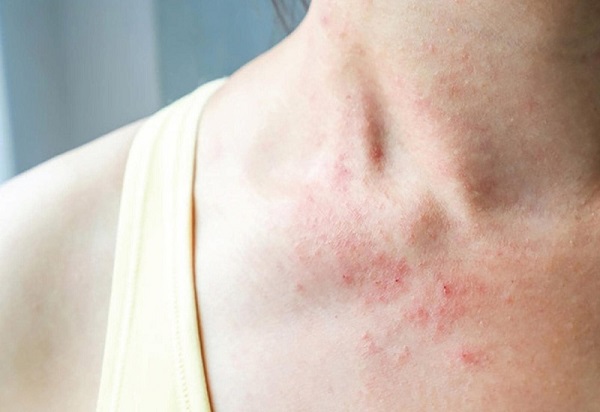 Nếu bị dị ứng nước hoa kéo dài bạn cần tìm đến bác sĩ chuyên khoa