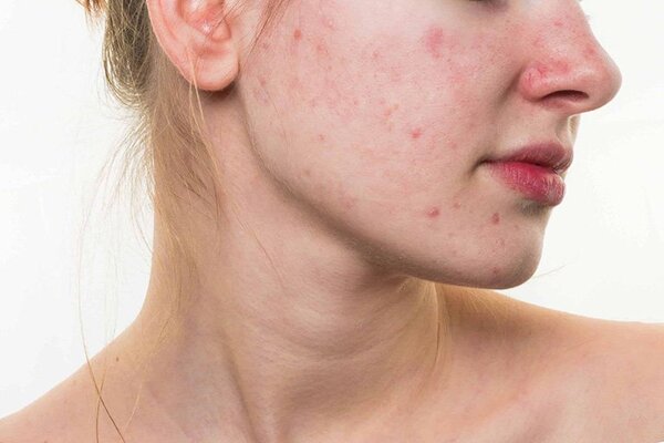 Fragrance có thể làm dị ứng